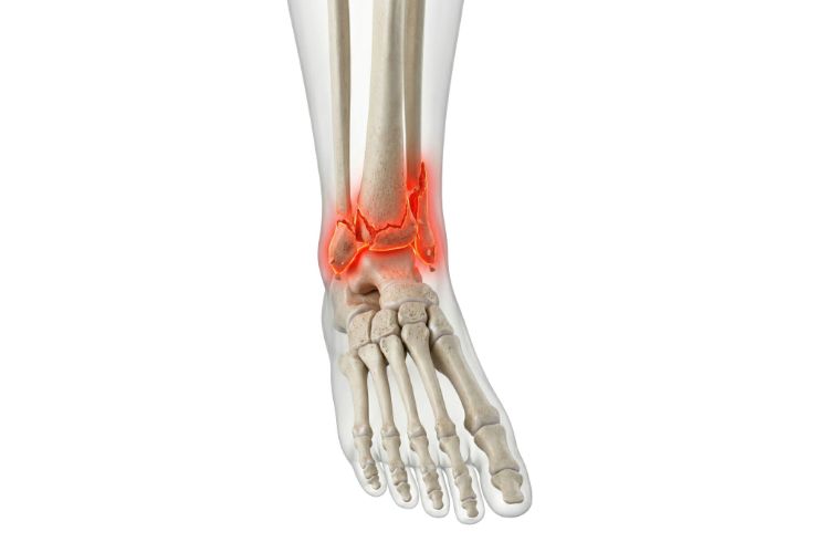 complex joint fracture treatment