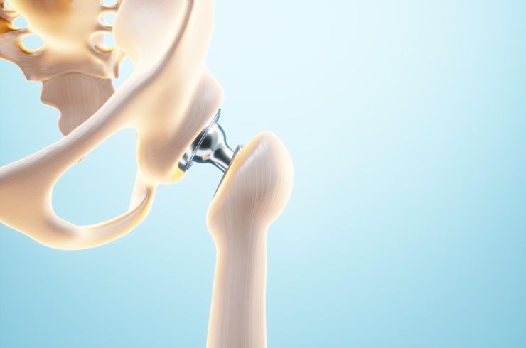 hip joint replacement