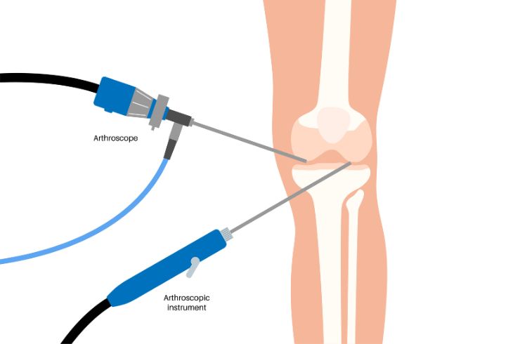 knee arthroscopy