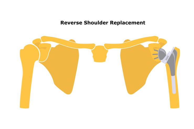 reverse shoulder replacement