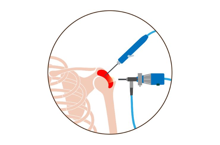 shoulder arthroscopy