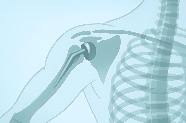 shoulder replacement
